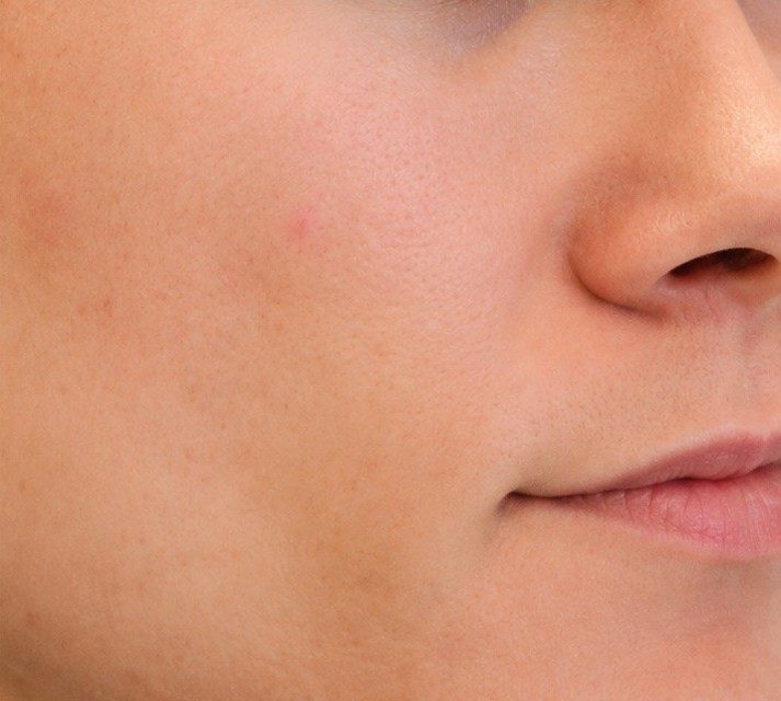 Skin after 2 weeks of B5 serum