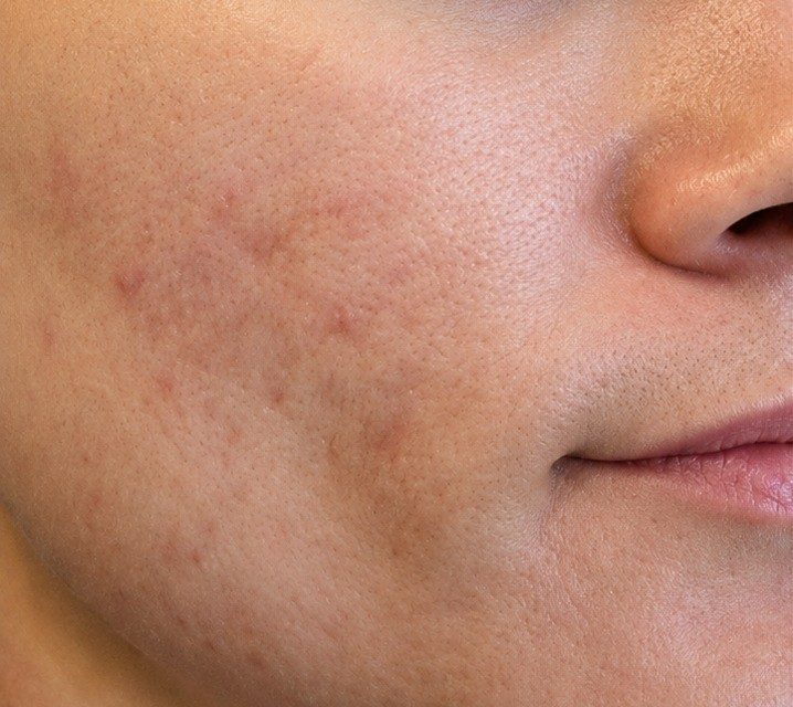 Skin before using B5 serum